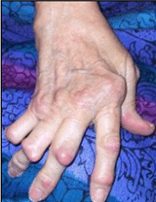 Bàn tay biến dạng do viêm khớp
